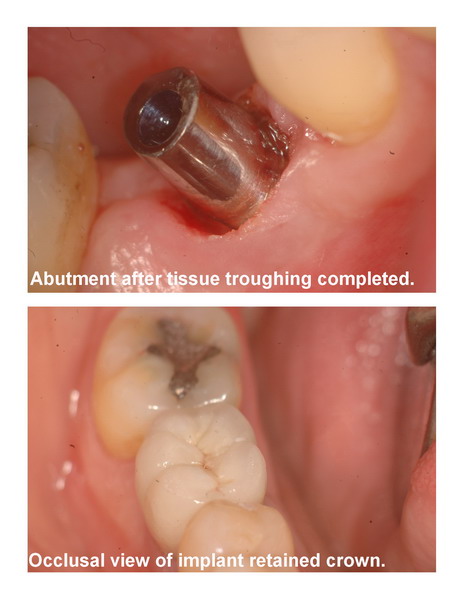 Implant seating pg 4 edited_resize.jpg